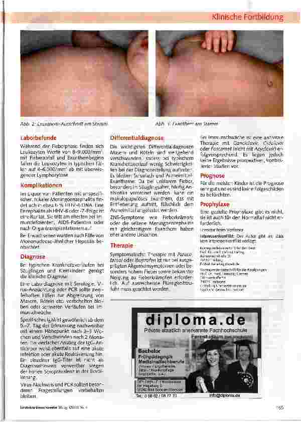 Vorschauseite 2: Exanthema subitum -Dreitagefieber - HHV-6-Infektion - Roseola infantum -6. Krankheit