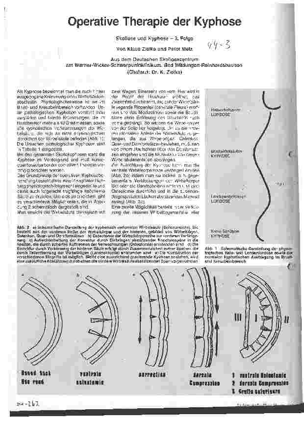 Vorschauseite 1: Operative Therapie der Kyphose
