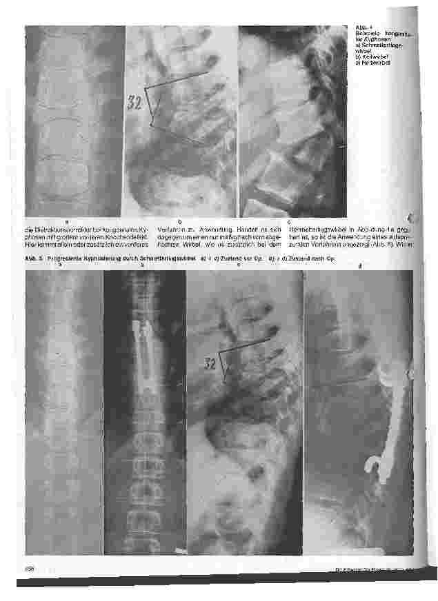 Vorschauseite 3: Operative Therapie der Kyphose