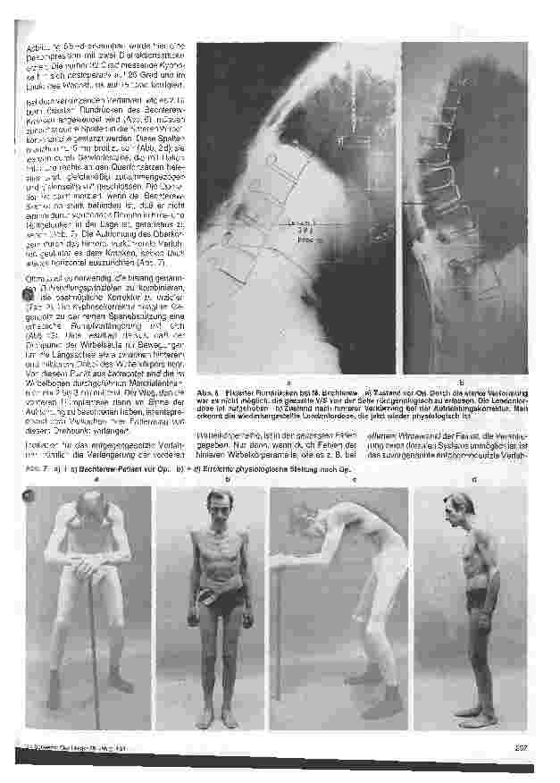 Vorschauseite 4: Operative Therapie der Kyphose