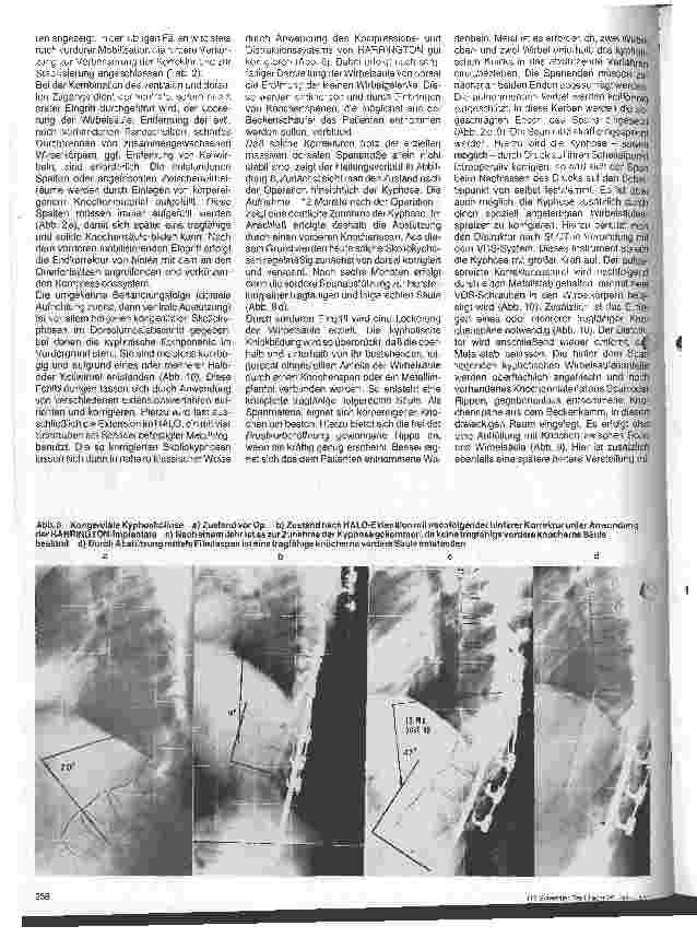 Vorschauseite 5: Operative Therapie der Kyphose