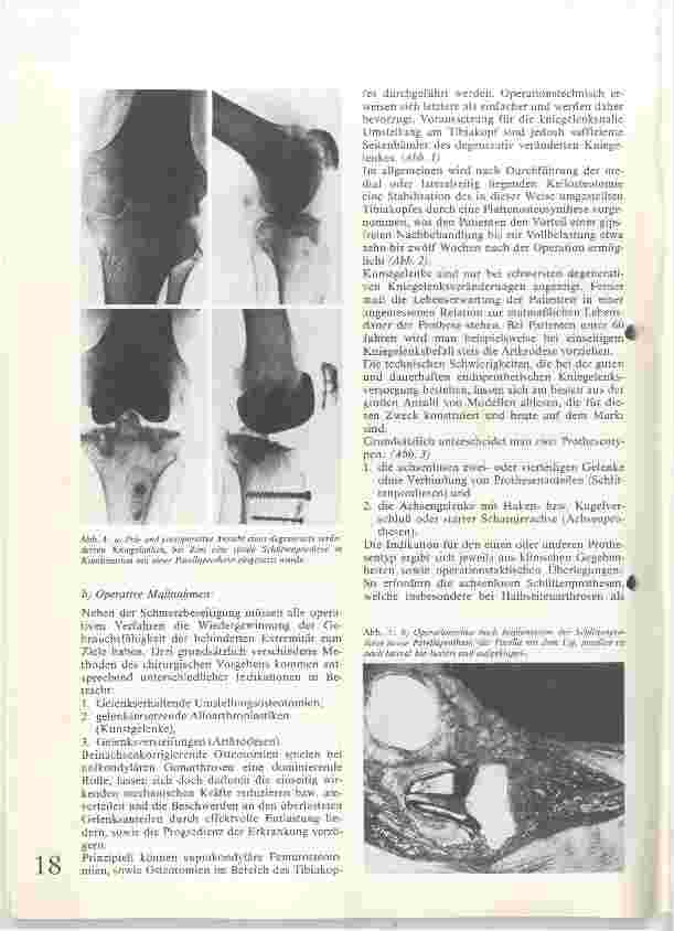 Vorschauseite 3: Ursachen und Therapie der Gonarthrose