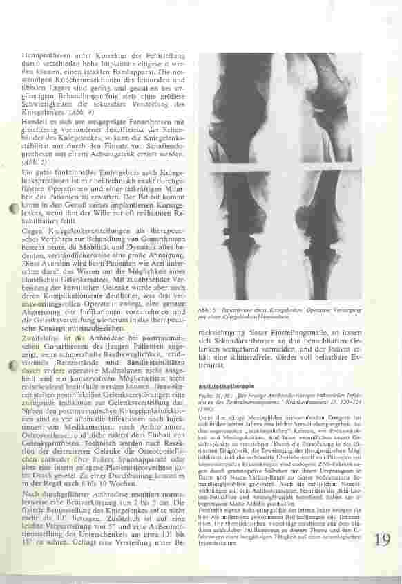 Vorschauseite 4: Ursachen und Therapie der Gonarthrose