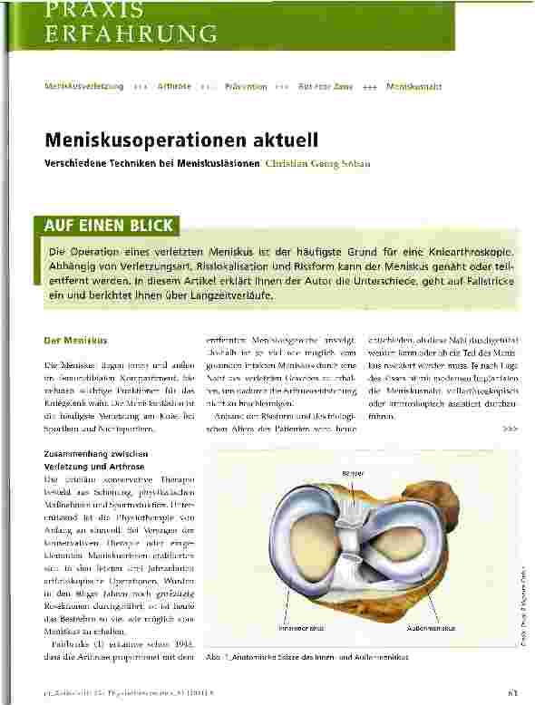 Vorschauseite 1: Meniskusoperationen aktuell