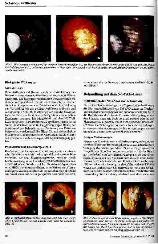 Vorschauseite 2: Möglichkeiten der endoskopischen Laserbehandlung im Tracheobronchialsystem