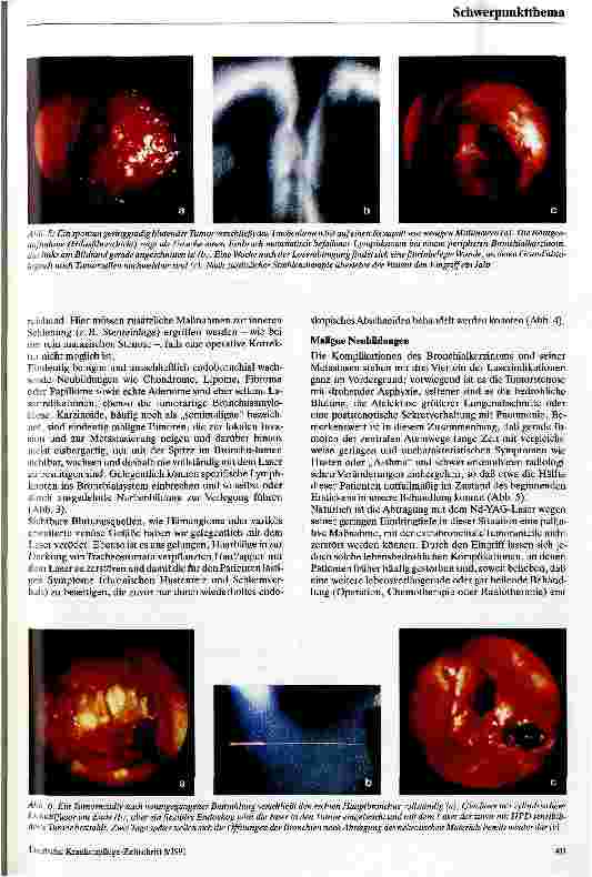 Vorschauseite 3: Möglichkeiten der endoskopischen Laserbehandlung im Tracheobronchialsystem