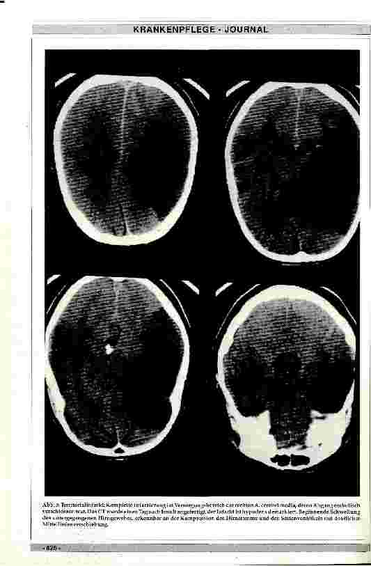 Vorschauseite 3: Pathophysiologie der Hirninfarkte