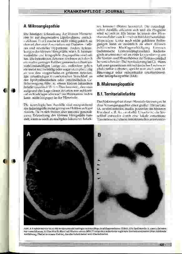 Vorschauseite 4: Pathophysiologie der Hirninfarkte