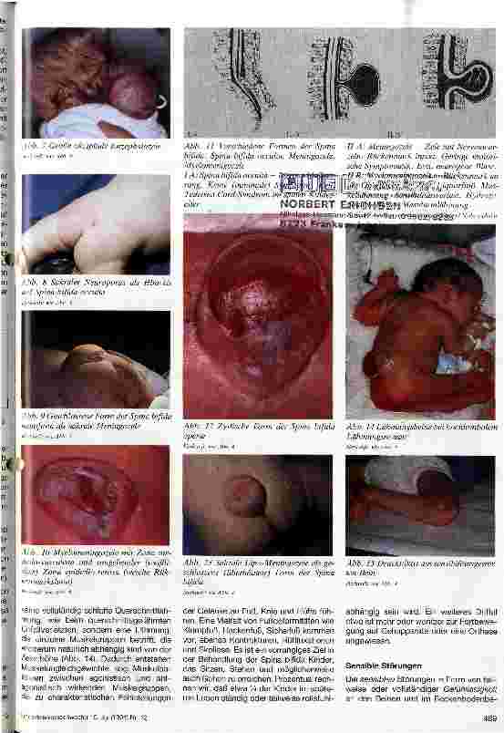 Vorschauseite 4: Entstehung, Formenvielfalt und Klinik der Neuralrohrdefekte