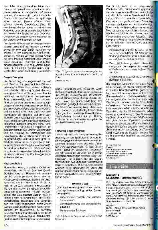 Vorschauseite 5: Entstehung, Formenvielfalt und Klinik der Neuralrohrdefekte