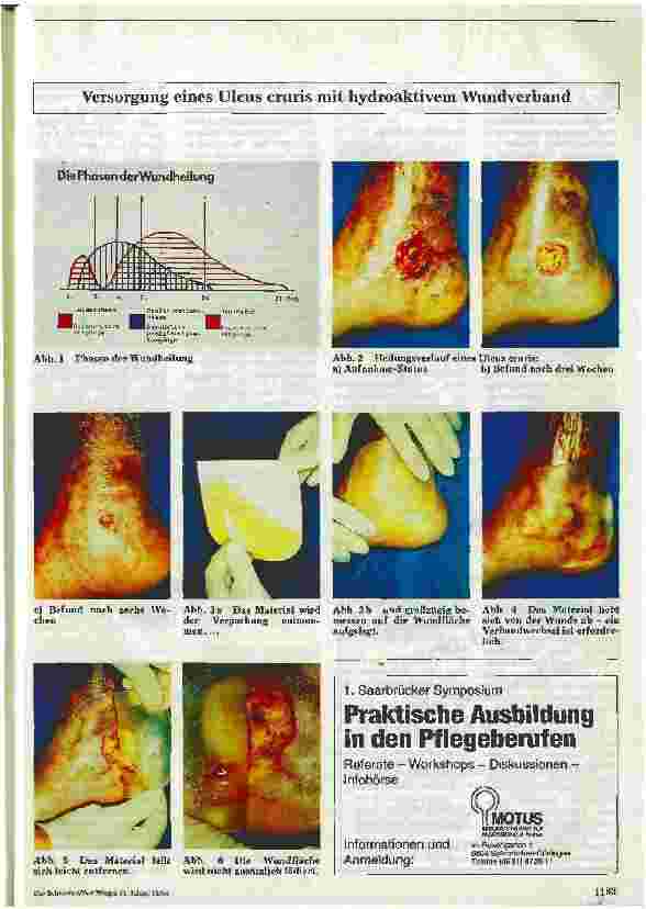 Vorschauseite 2: Ulcus-Cruris-Therapie mit hydroaktiven Wundverbänden