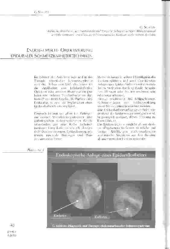 Vorschauseite 1: Endoskopische Objektivierung epiduraler Schmerzkathetertechniken