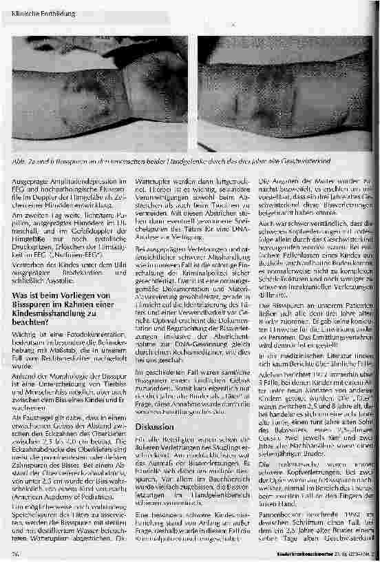 Vorschauseite 2: Bissspuren bei Kindesmisshandlung mit Todesfolge