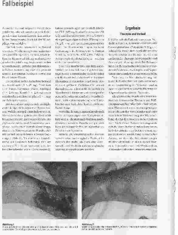 Vorschauseite 2: Individueller Heilversuch mit Prostaglandin-E1 (PGE1) bei einer Patientin mit therapieresistenten, tiefen Hautnekrosen als Komplikation eines CINCA-Syndroms