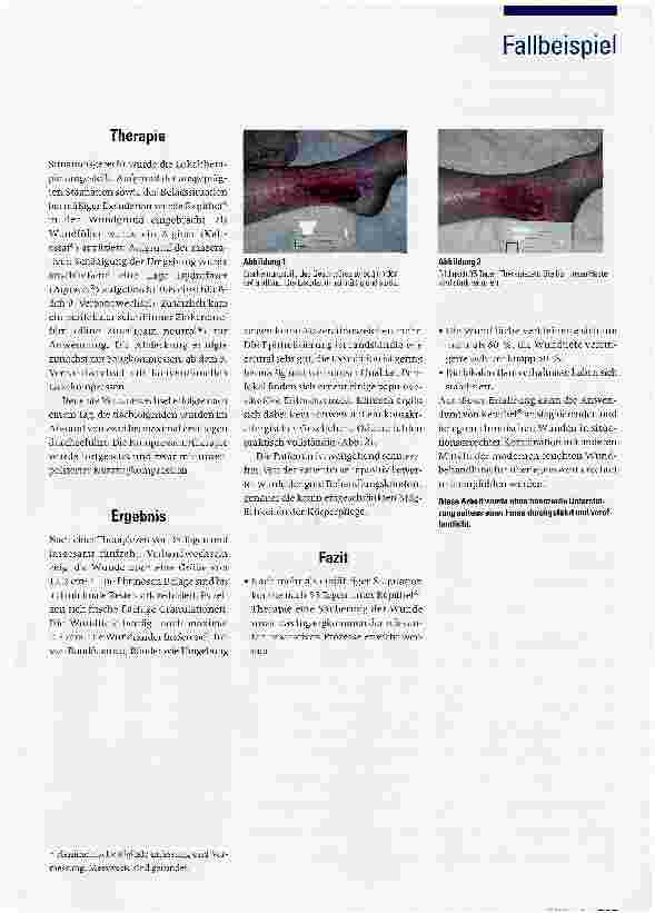 Vorschauseite 2: Behandlung eines stagnierenden Ulcus cruris venosum