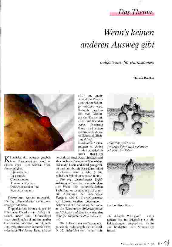 Vorschauseite 1: Wenns keinen anderen Ausweg gibt Indikationen für Darmstomata