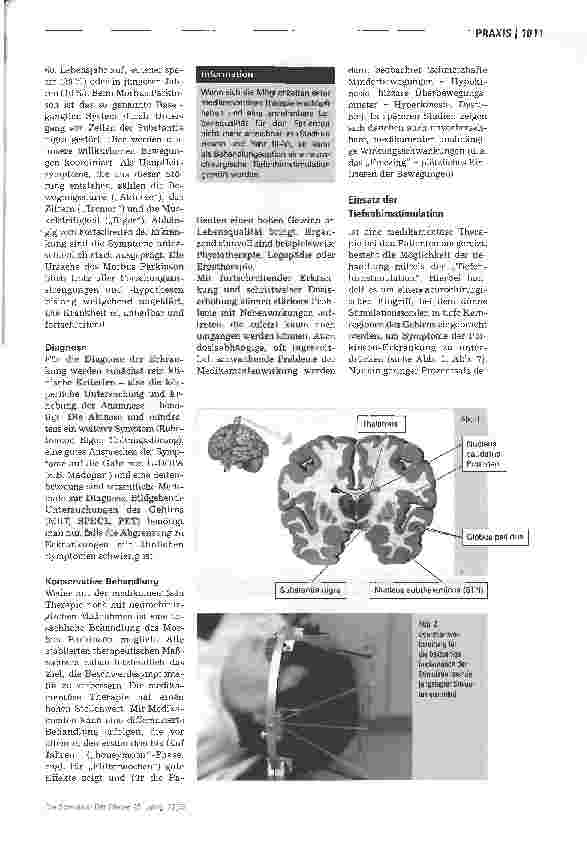 Vorschauseite 2: Tiefenhirnstimulation - Perioperative Betreuung von Parkinson-Patienten