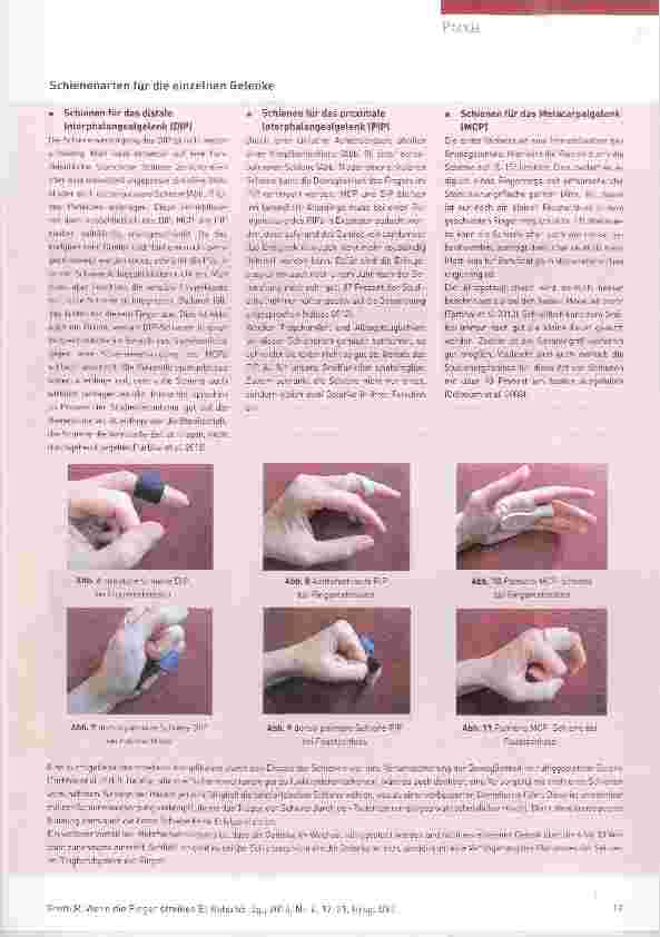 Vorschauseite 3: Wenn die Finger streiken Schienenversorgung bei Tendovaginitis stenosans