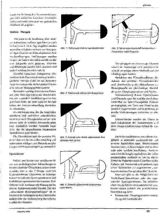 Vorschauseite 5: Portale Hypertension mit Ösophagusvarizenblutung