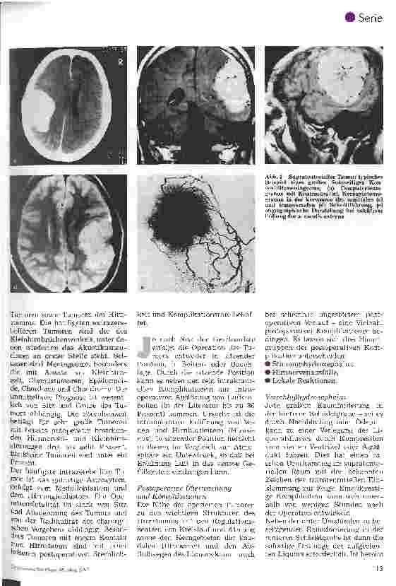 Vorschauseite 2: Postoperative Pflege in der Neurochirurgie 5. Folge: Postoperative Überwachung nach Operationen intrakranieller Tumoren