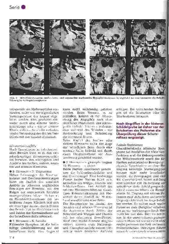 Vorschauseite 3: Postoperative Pflege in der Neurochirurgie 5. Folge: Postoperative Überwachung nach Operationen intrakranieller Tumoren