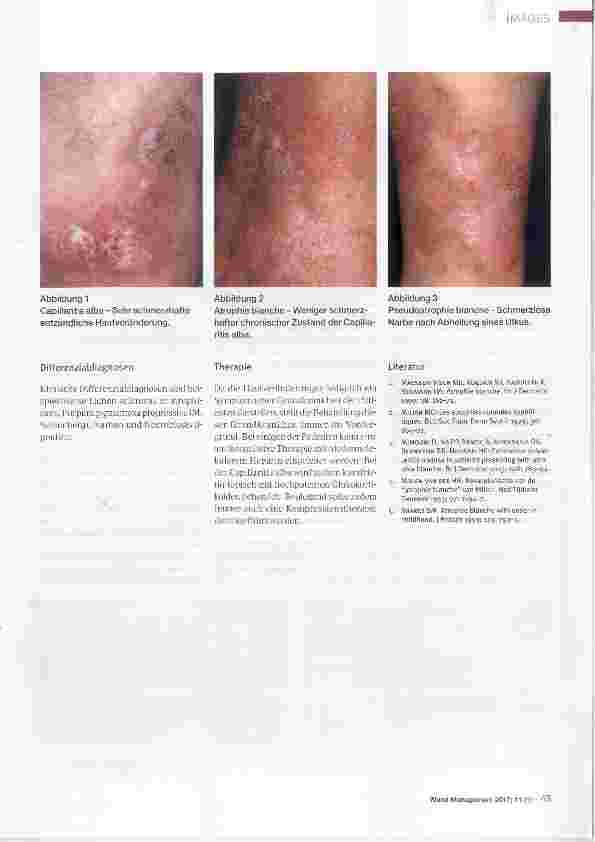 Vorschauseite 2: Capillaritis alba und Atrophie blanche