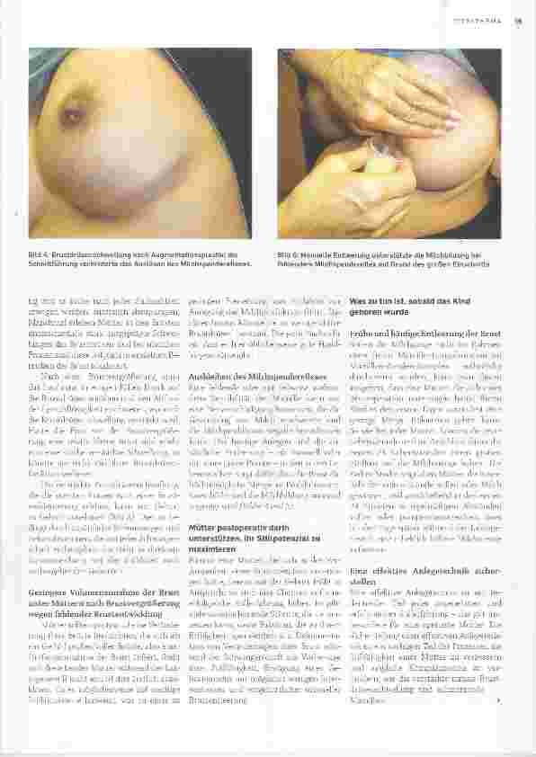 Vorschauseite 5: Stillen nach kosmetischer Brustoperation