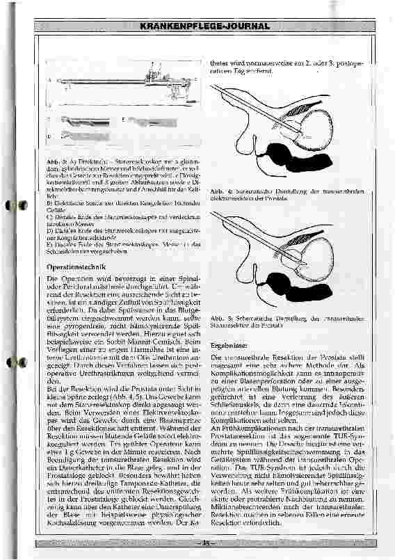 Vorschauseite 2: Transurethrale Operationstechniken bei Tumoren der Blase und der Prostata