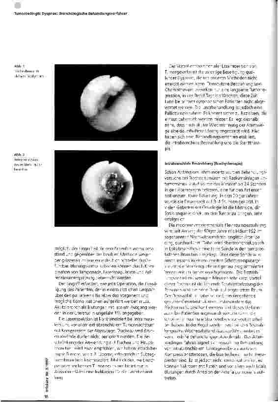 Vorschauseite 2: Tumorbedingte Dyspnoe: Bronchologische Behandlungsverfahren