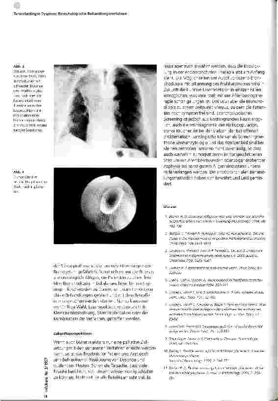 Vorschauseite 4: Tumorbedingte Dyspnoe: Bronchologische Behandlungsverfahren