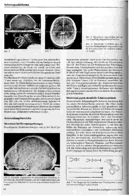 Vorschauseite 2: Stereotaktische Hirnoperationen