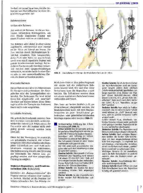 Vorschauseite 4: Konstruktionsund Montageprinzipien des Fixateur externe