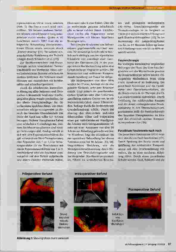 Vorschauseite 3: Die Chirurgie des Ulcus cruris venosum