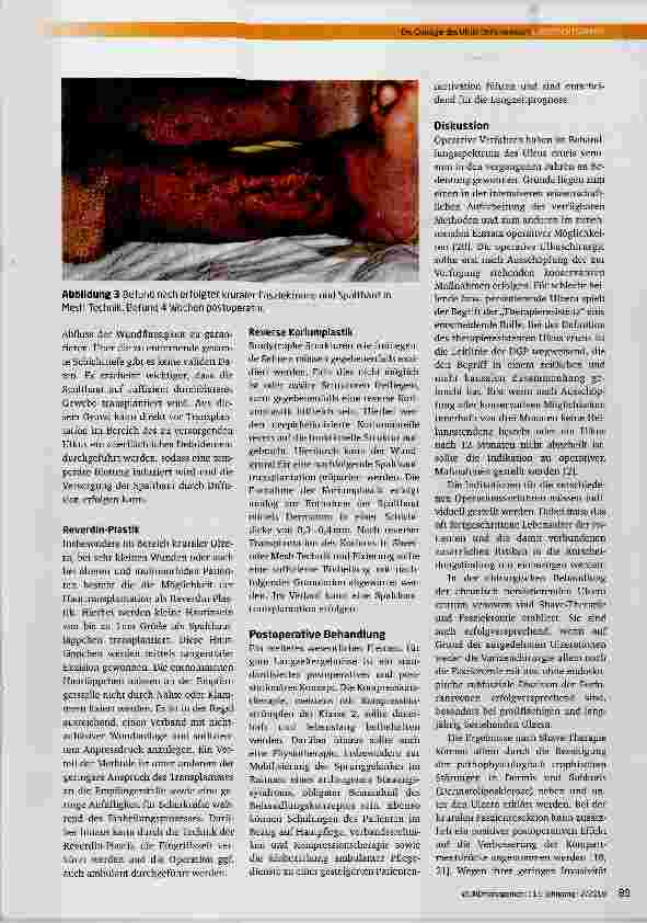 Vorschauseite 5: Die Chirurgie des Ulcus cruris venosum