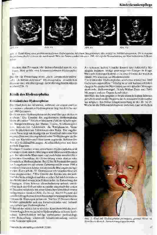 Vorschauseite 3: Der kindliche Hydrozephalus und seine Behandlung