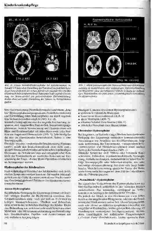 Vorschauseite 4: Der kindliche Hydrozephalus und seine Behandlung