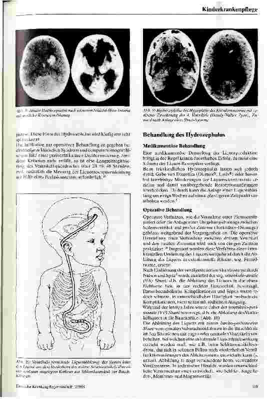 Vorschauseite 5: Der kindliche Hydrozephalus und seine Behandlung
