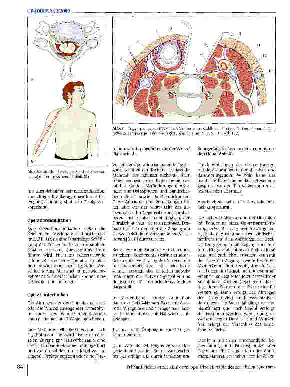 Vorschauseite 3: Klinik und operative Therapie des zervikalen Syndroms