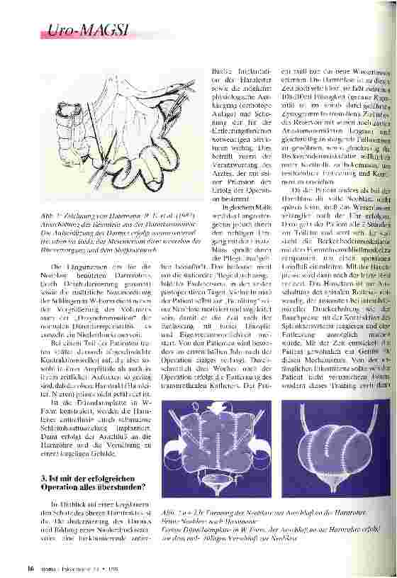 Vorschauseite 2: Die Ileum-Neoblase 1. Teil: Miktion via naturalis