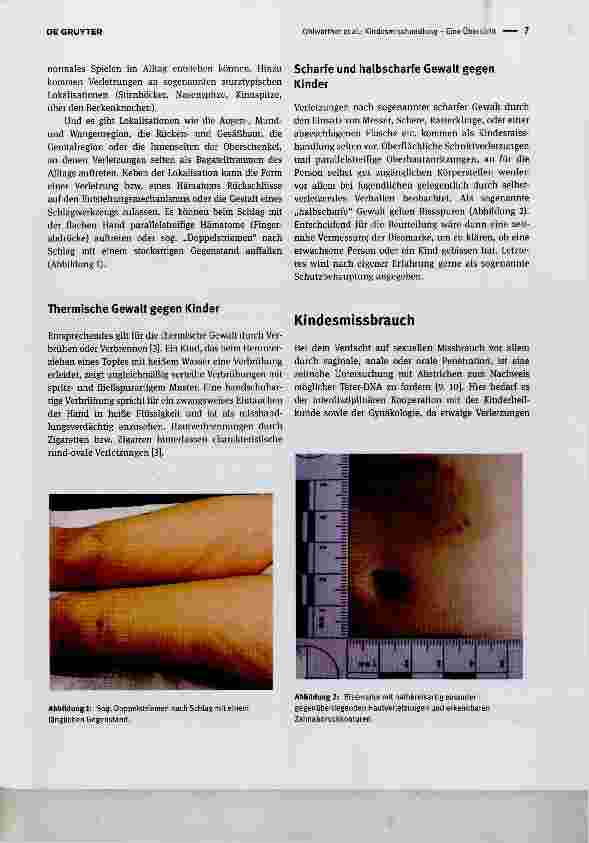 Vorschauseite 2: Kindesmisshandlung Eine Übersicht Child abuse an overview