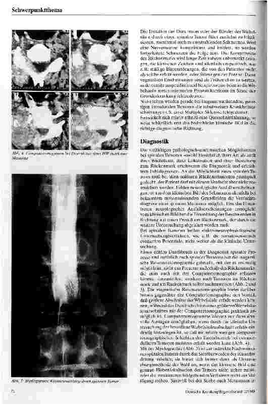 Vorschauseite 3: Spinale Tumoren