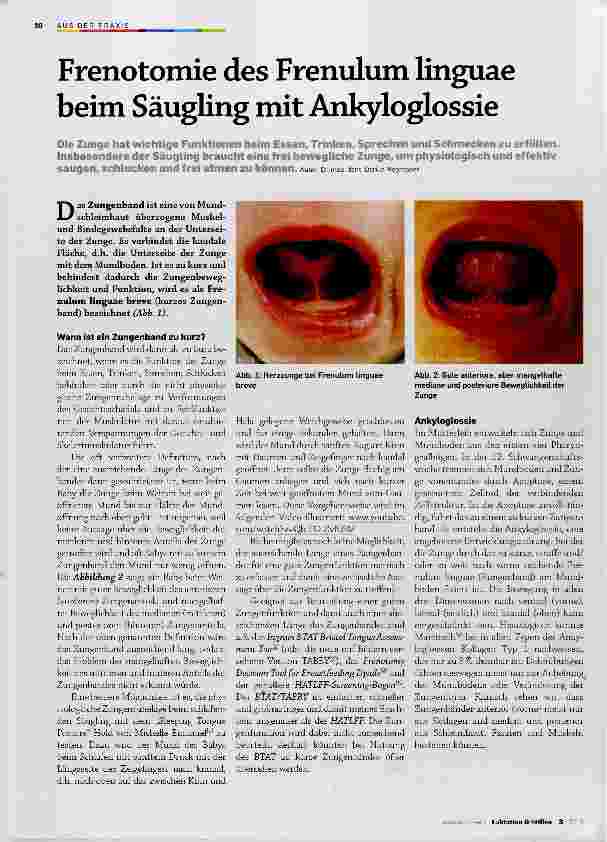 Vorschauseite 1: Frenotomie des Frenulum linguae beim Säugling mit Ankyloglossie