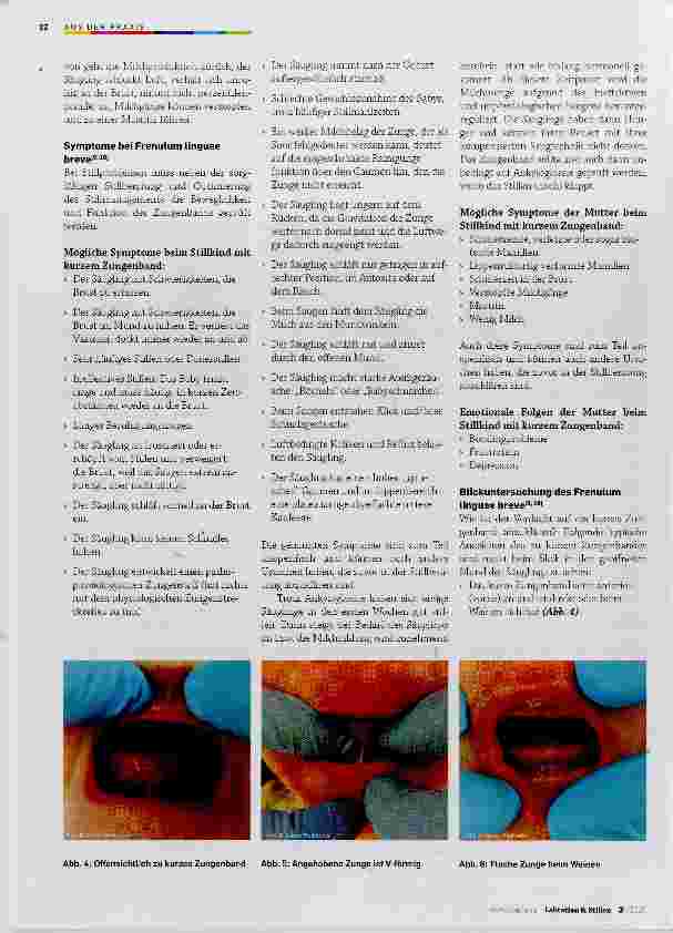Vorschauseite 3: Frenotomie des Frenulum linguae beim Säugling mit Ankyloglossie