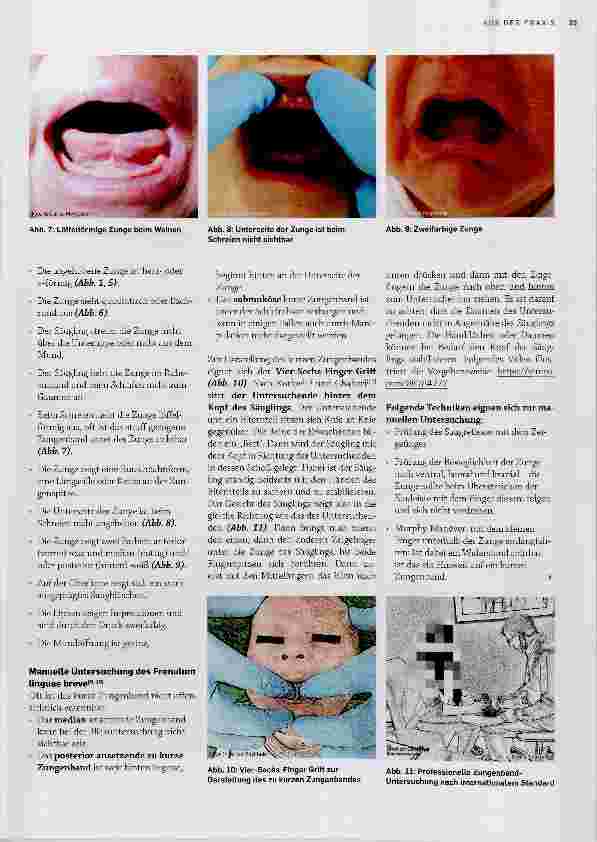Vorschauseite 4: Frenotomie des Frenulum linguae beim Säugling mit Ankyloglossie