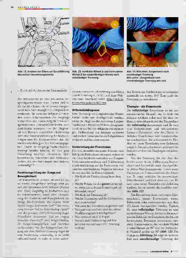 Vorschauseite 5: Frenotomie des Frenulum linguae beim Säugling mit Ankyloglossie