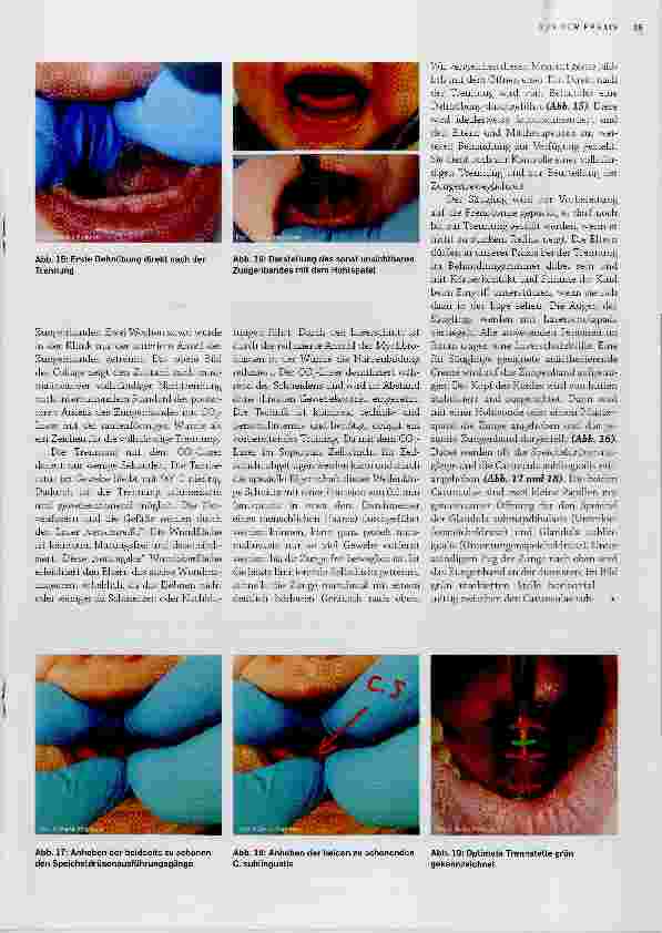 Vorschauseite 6: Frenotomie des Frenulum linguae beim Säugling mit Ankyloglossie