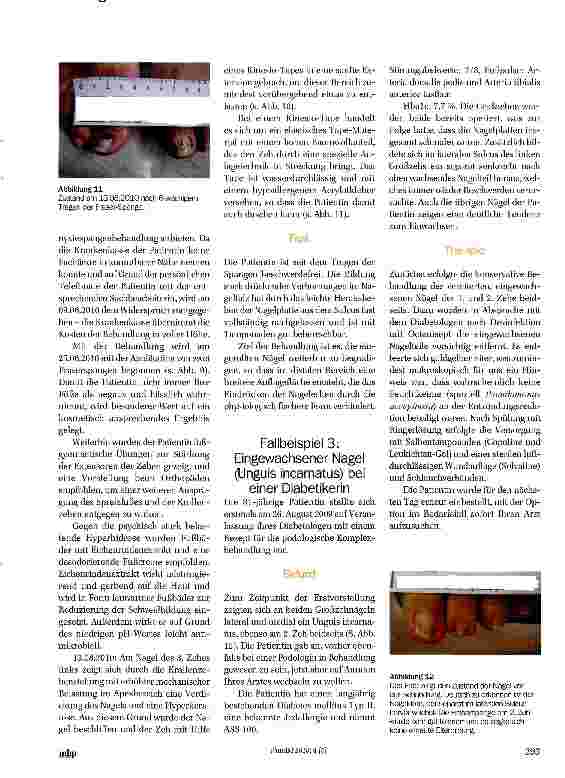 Vorschauseite 4: Fallbeispiele für Anwendungen von Orthonyxiespangen