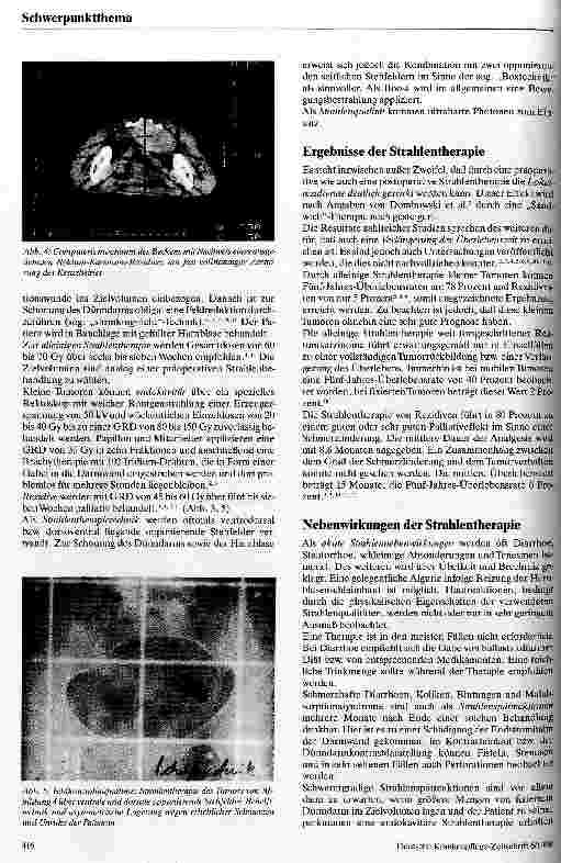 Vorschauseite 3: Möglichkeiten und Grenzen der Strahlentherapie beim Rektumkarzinom