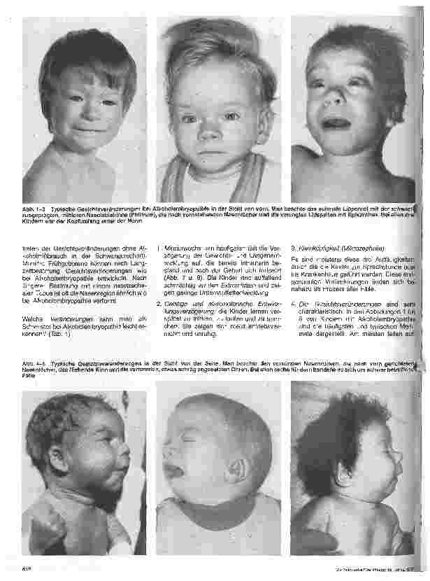 Vorschauseite 3: Alkoholembryopathie und Frauenalkoholismus