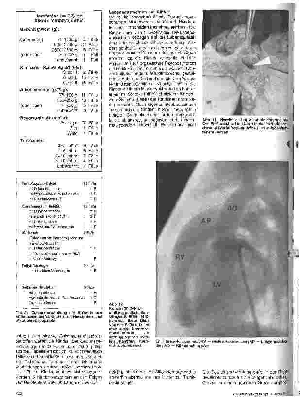 Vorschauseite 6: Alkoholembryopathie und Frauenalkoholismus